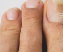 Как лечить грибок ногтей на руках в домашних условиях Реально вылечить грибок ногтей в домашних условиях